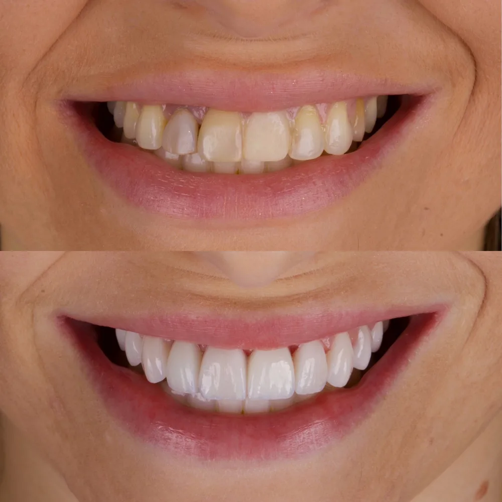 Resultado de lentes de contato dental, caso 3