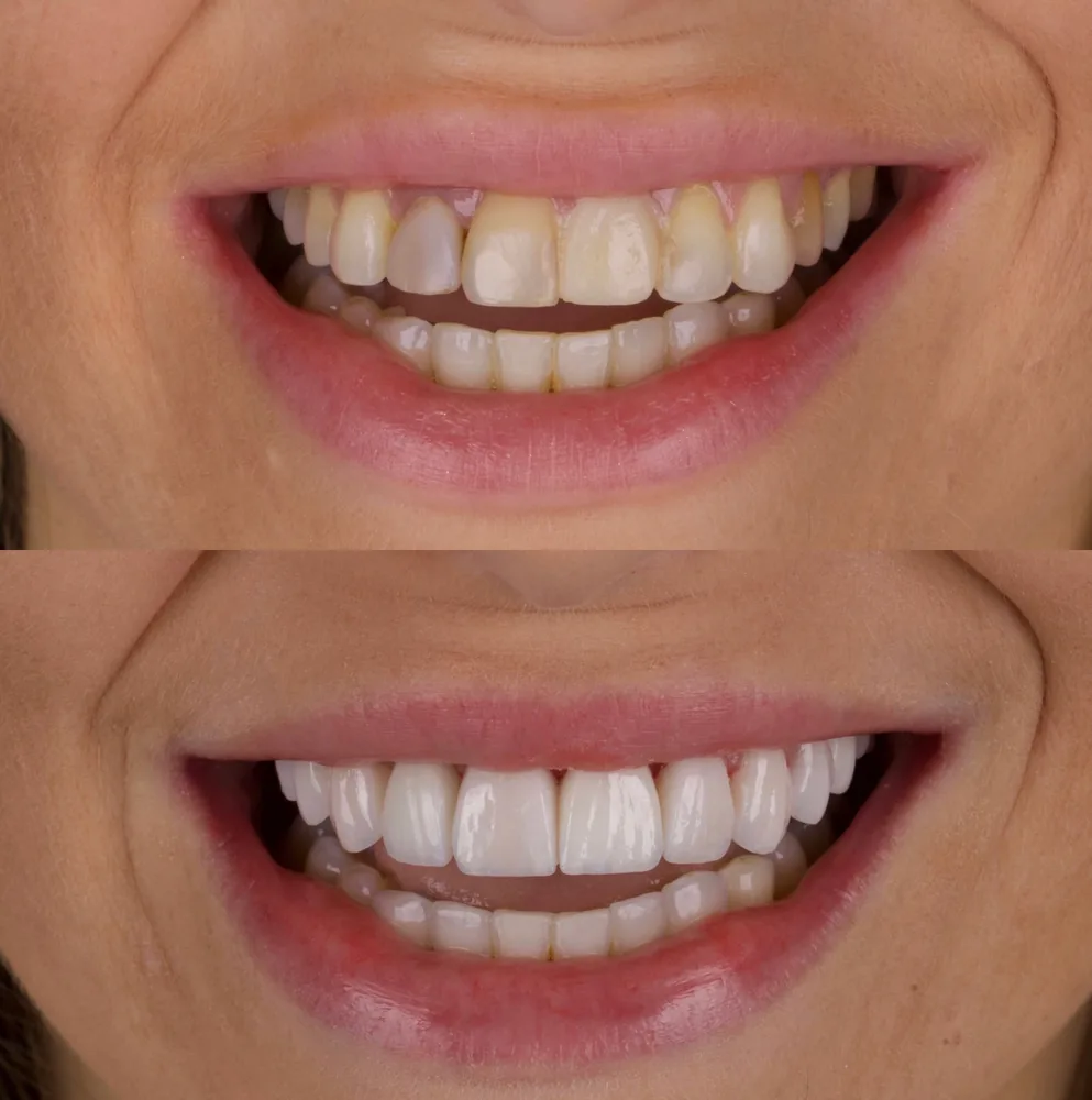 Resultado de lentes de contato dental, caso 4