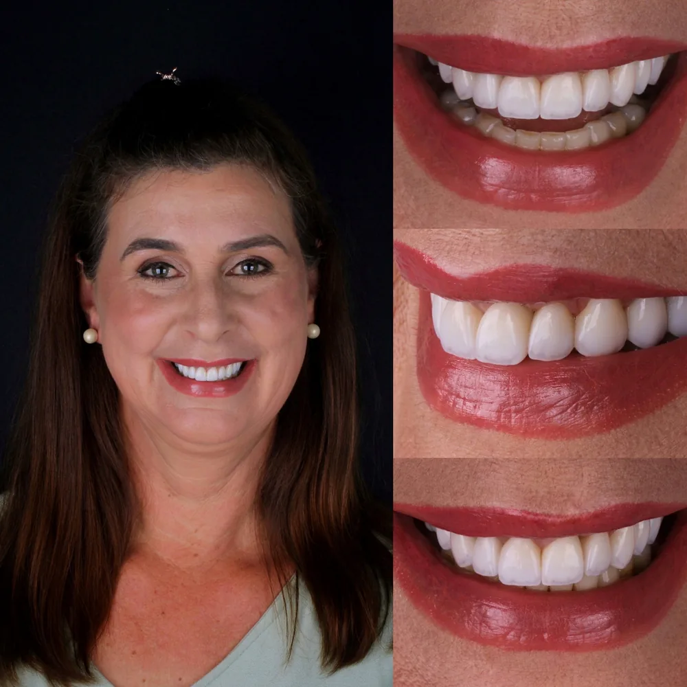 Resultado de lentes de contato dental, caso 7