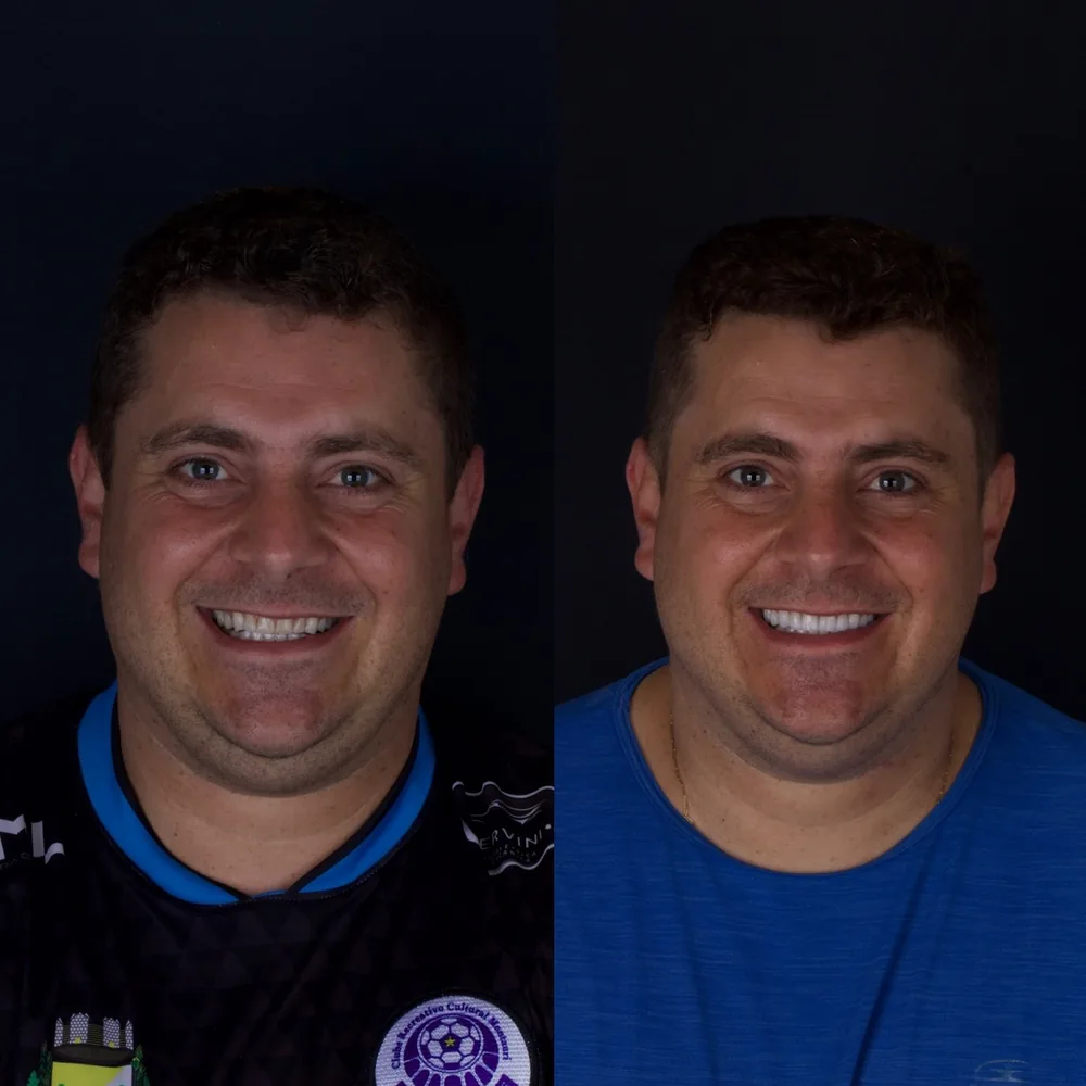 Resultado de lentes de contato dental, caso 9