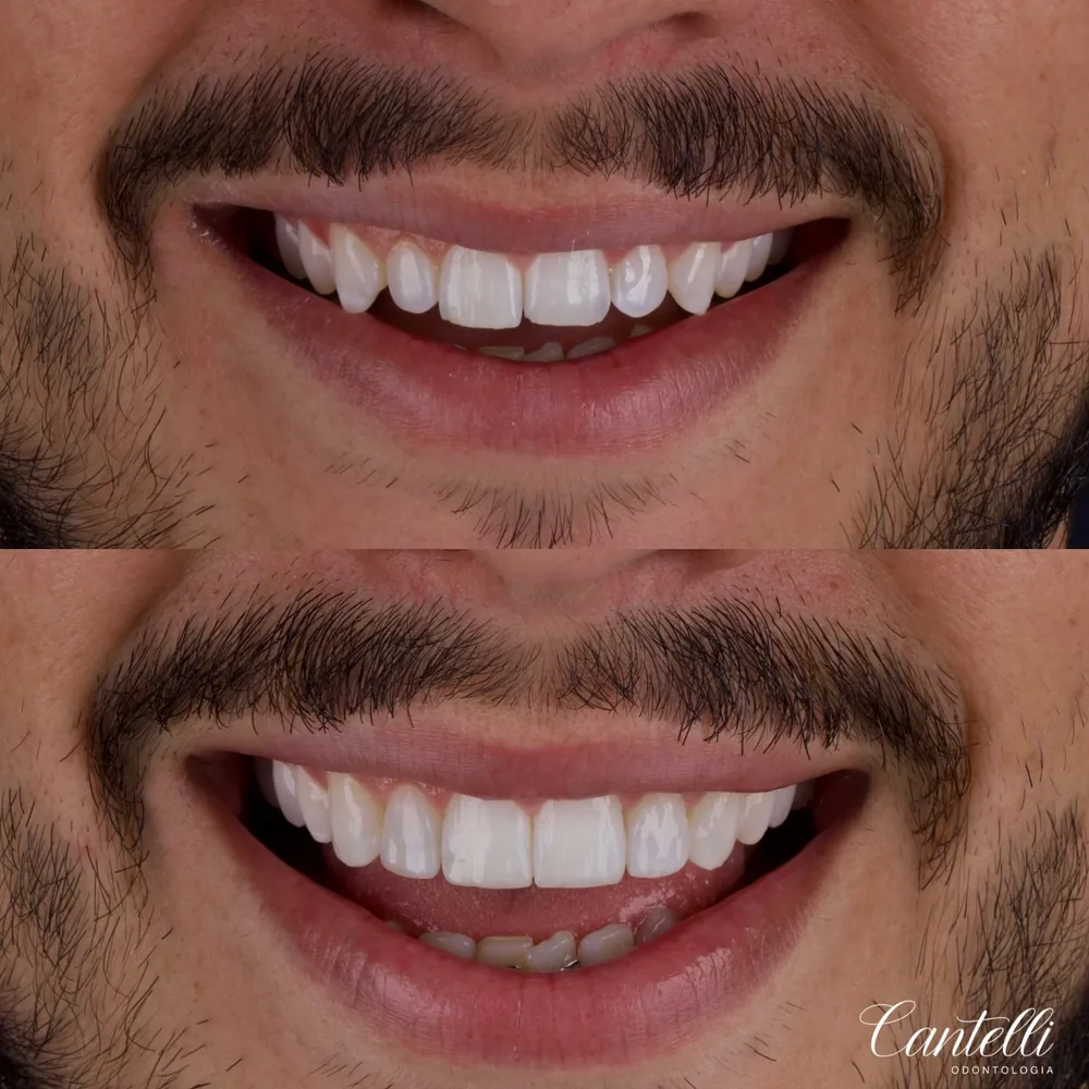 Resultado de lentes de contato dental, caso 11