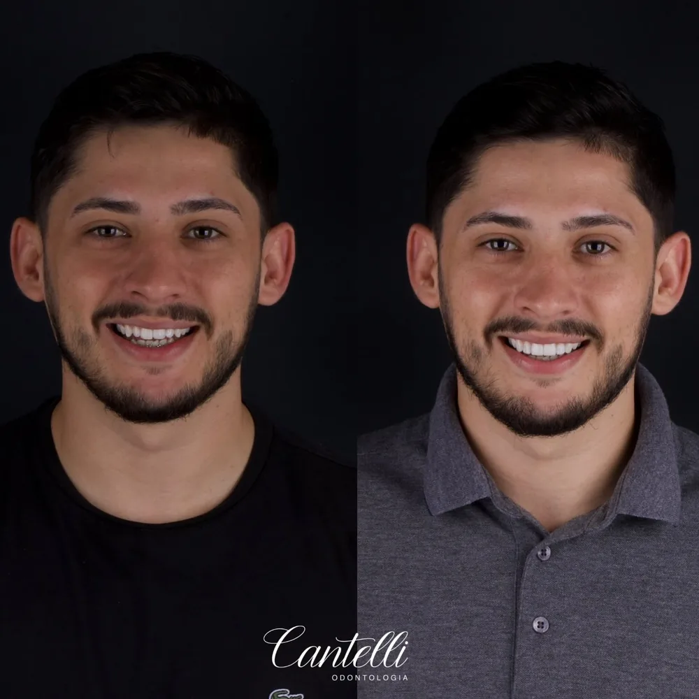 Resultado de lentes de contato dental, caso 12