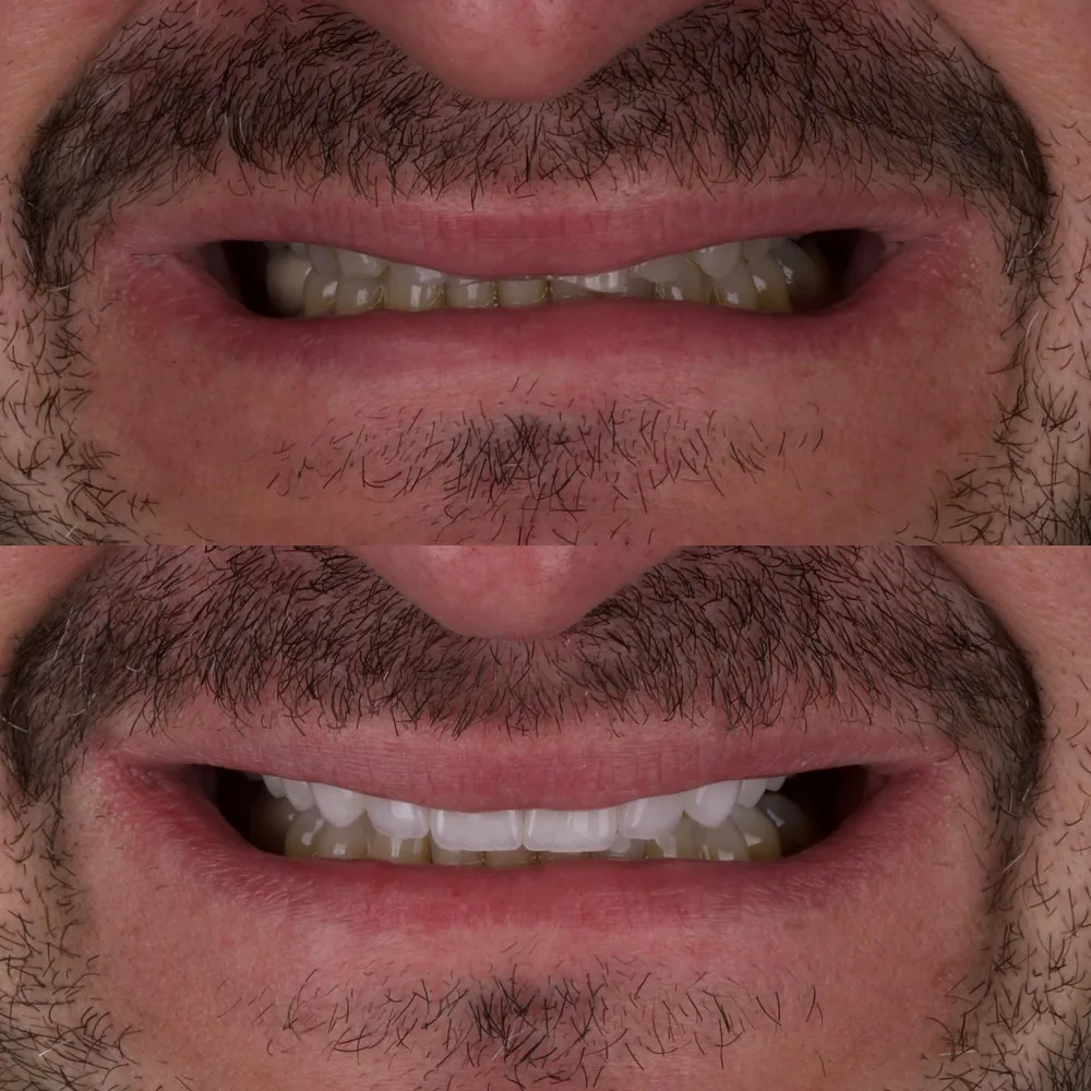 Resultado de lentes de contato dental, caso 16