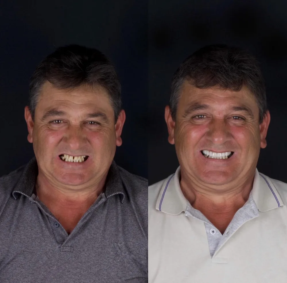 Resultado de lentes de contato dental, caso 21